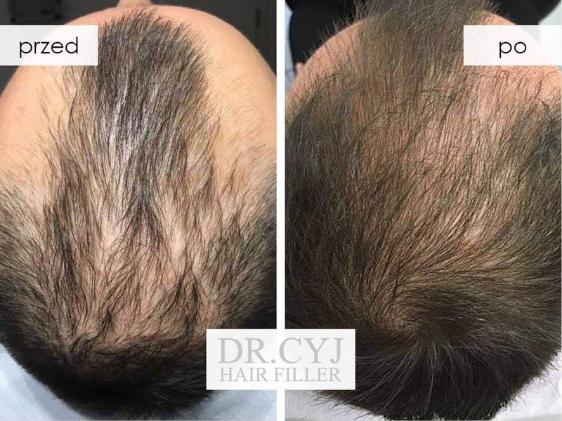 Poland - tricho mist forte